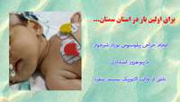  جراحی پیلوستومی در نوزاد شیرخوار ۶۰ روزه با پیونفروز انسدادی ناشی از حالب اکتوپیک سیستم منفرد چپ 