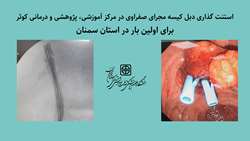 برای اولین بار در استان سمنان استنت گذاری دبل کیسه مجرای صفراوی در مرکز آموزشی، پژوهشی و درمانی کوثر انجام شد.